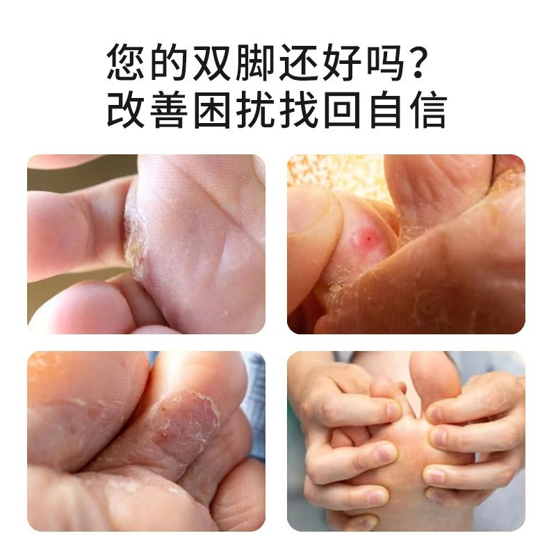 脚气偏方脚痒脱皮烂脚汗脚臭足部护理抑菌膏脚气膏OEM代加工厂图2