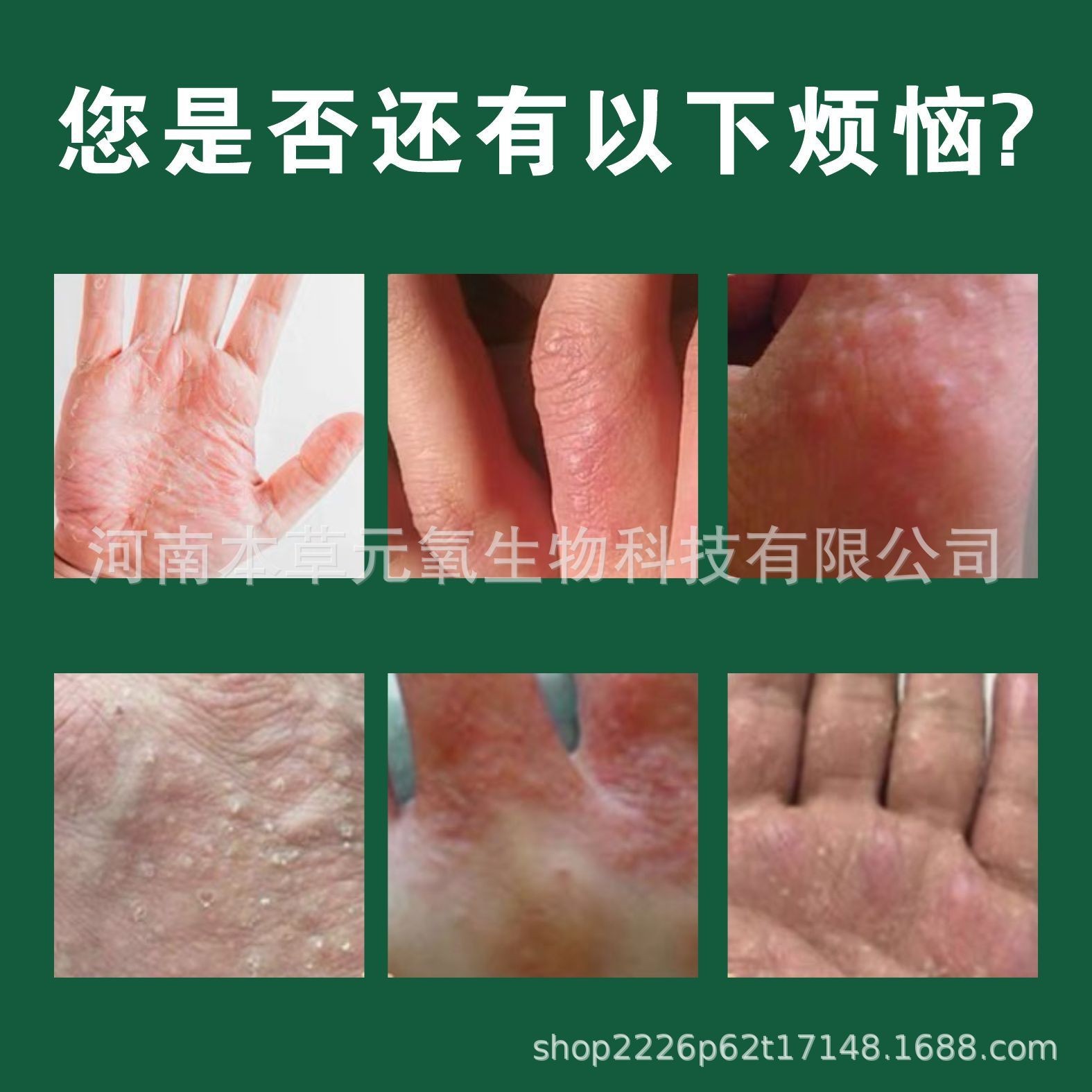 国药药材汗疱膏手足脱皮汗疱软膏水泡红热湿痒草本乳膏OEM代加工厂图4