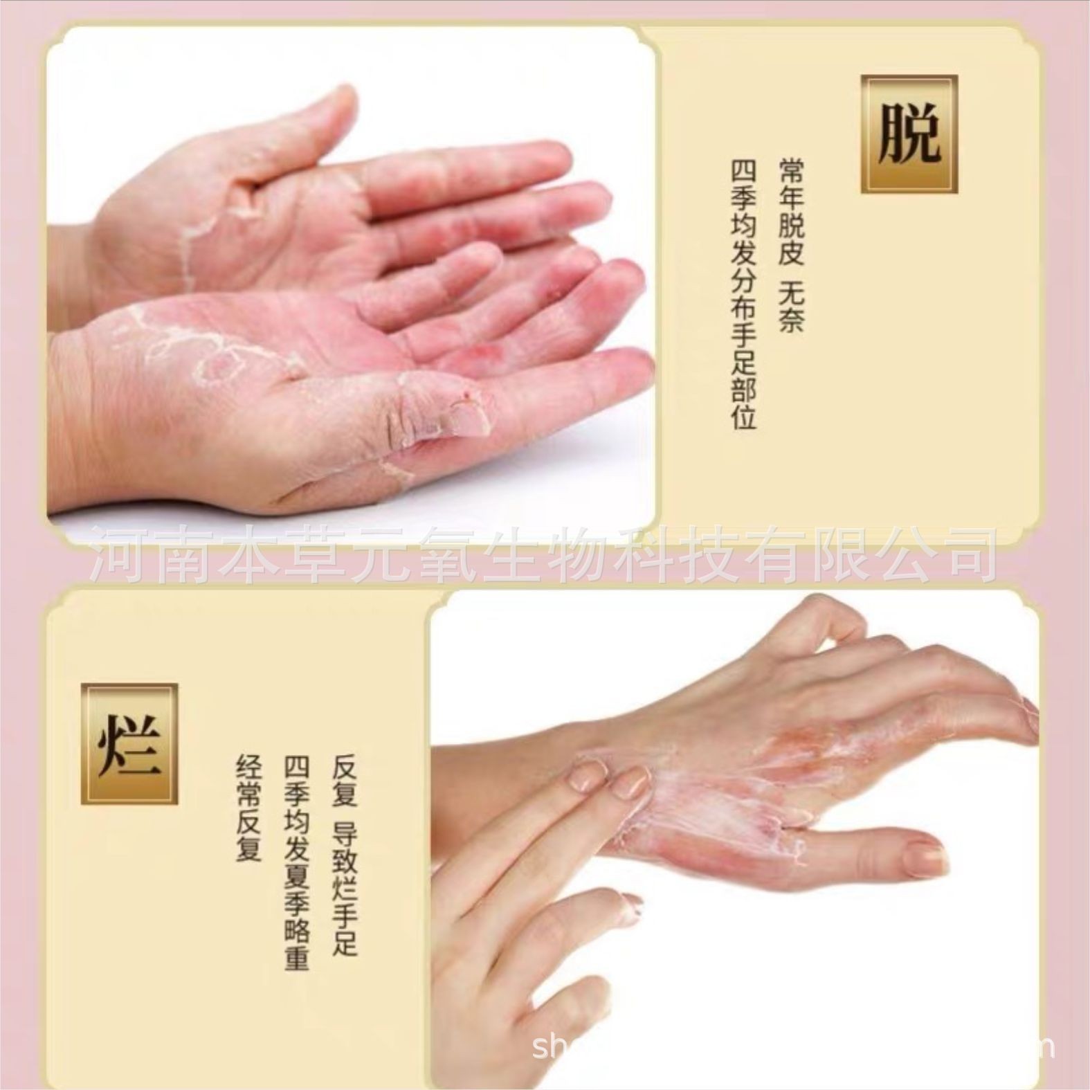 国药药材汗疱膏手足脱皮汗疱软膏水泡红热湿痒草本乳膏OEM代加工厂图3