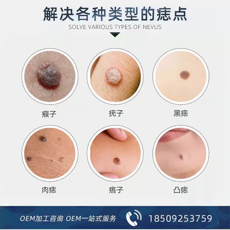 点痣祛疣膏皮肤抑菌膏液贴牌 去痣祛疣水扁平丝状尖锐湿生产厂家图4