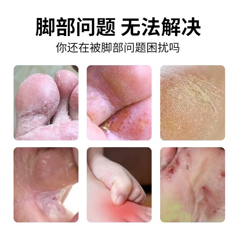 定制医用足部创面敷料贴牌臭脚喷雾剂去脚气水泡脚止痒脱皮药喷剂,代工智造图5