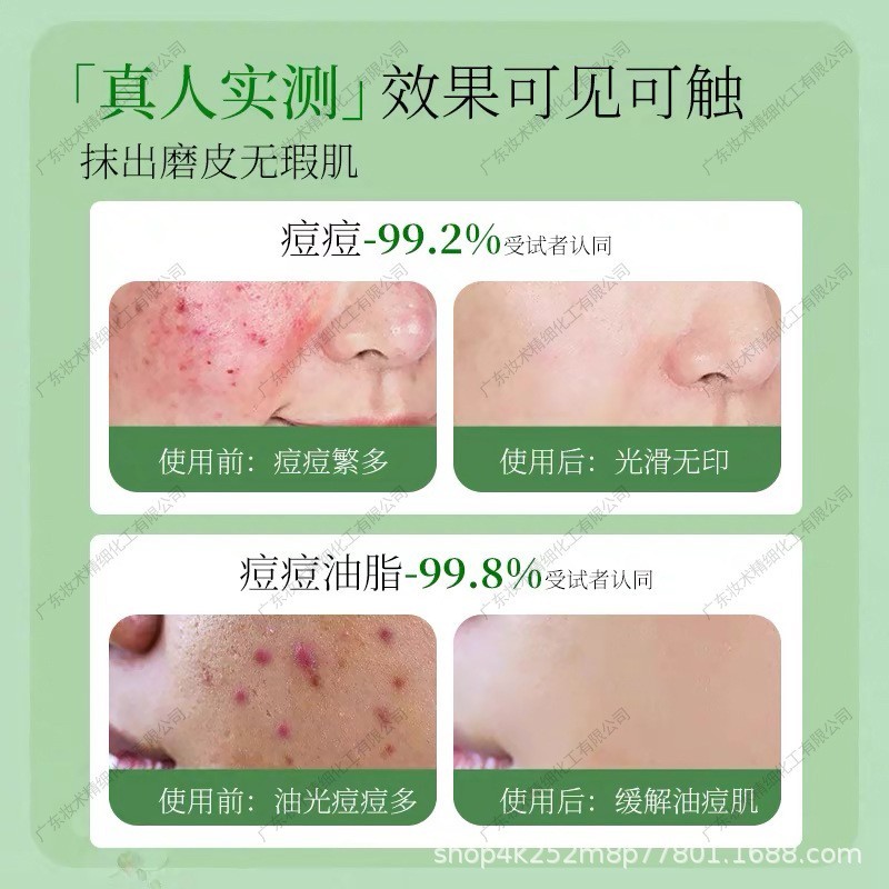 祛痘精华液修复青春痘祛痘印痘坑淡化收缩毛孔院线定制源头厂家图4