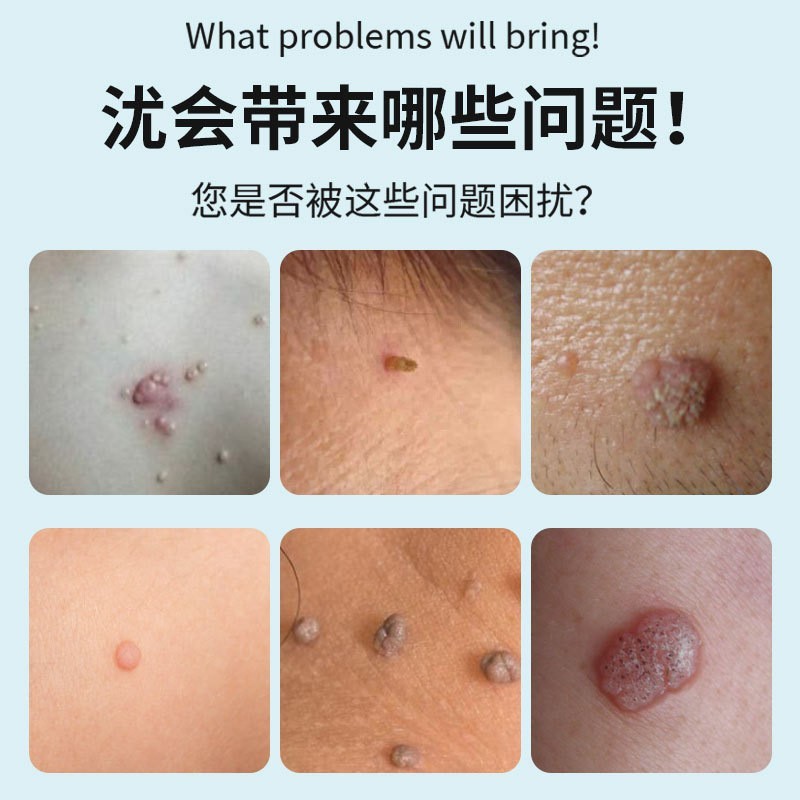 祛尤凝胶软膏医用退热凝胶一类字号尤瘊鸡眼肉刺小肉粒克去尤膏图2