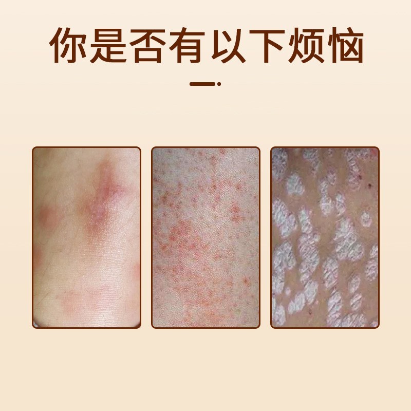 OEM皮肤湿痒膏痱子皮肤厂家癣痒灵药膏外用药膏麻荨瘙痒乳膏定制图2