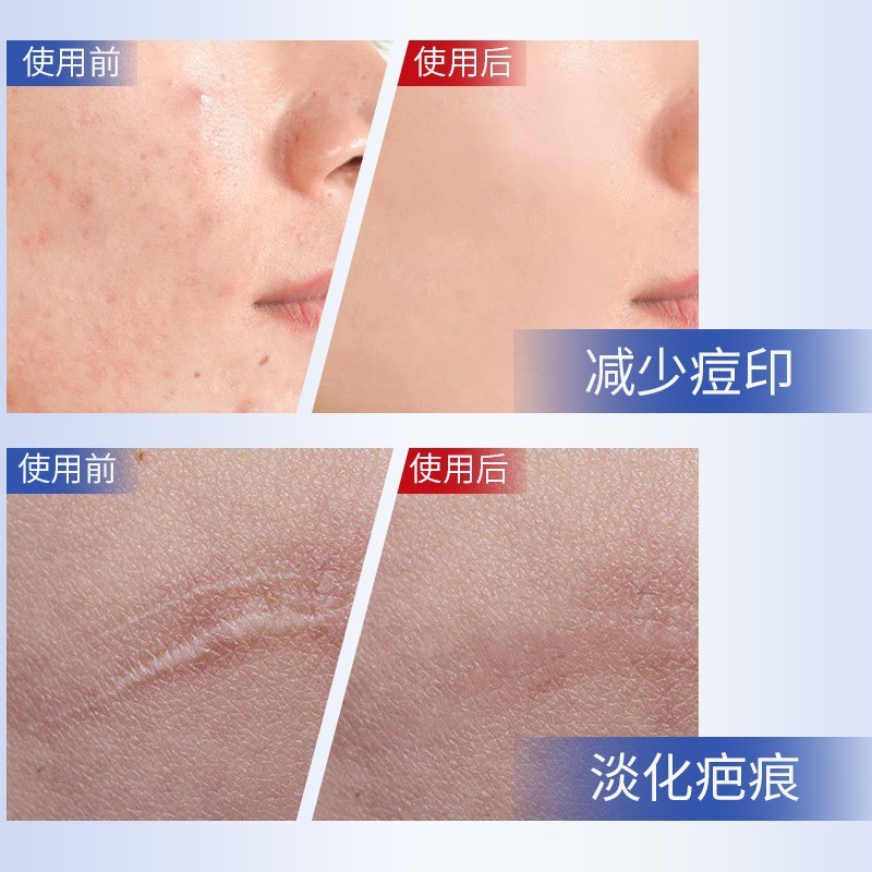 贴牌加工院线多肽破皮修护退红冰晶淡化痘疤印槲皮素光子冷敷凝胶图4