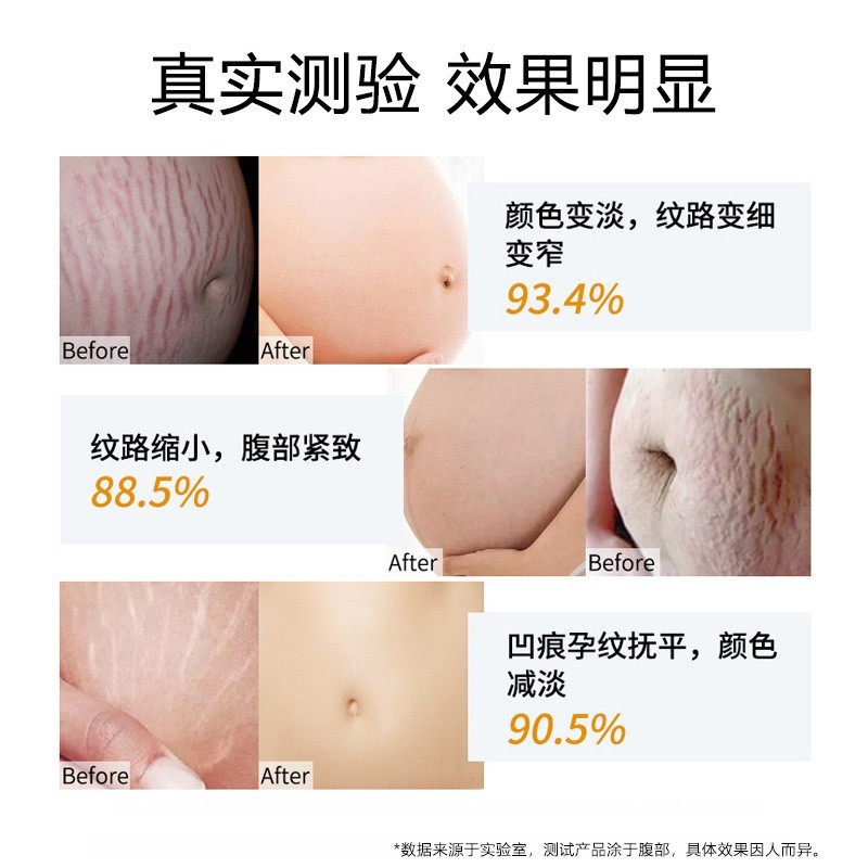 妊娠纹修复霜产后护理祛孕纹润肤预防妊娠纹生长纹院线疤痕膏修复图2