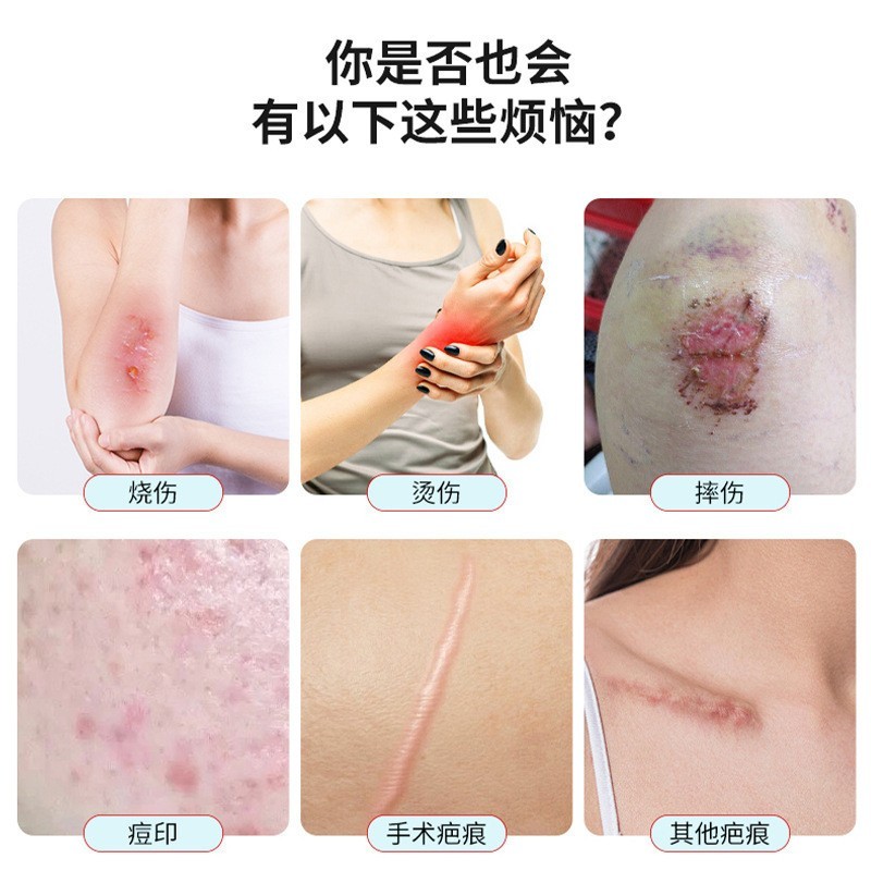 美容院疤痕膏去陈年旧疤术后增生疤烫伤剖腹产硅酮疤痕烫伤修复膏图2