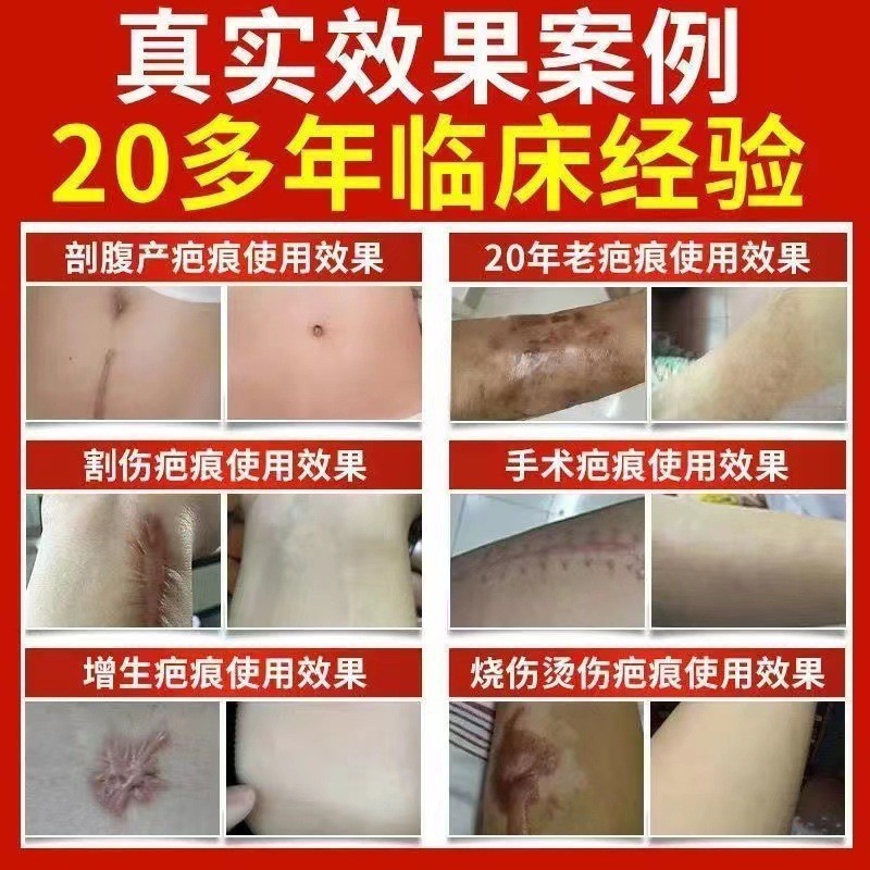 美容院疤痕膏去陈年旧疤术后增生疤烫伤剖腹产硅酮疤痕烫伤修复膏图4